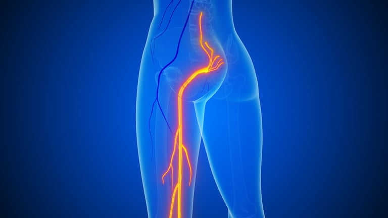 Medical illustration of sciatic nerve pain showing spine, lower back, and nerve pathways with inflammation extending to the legs